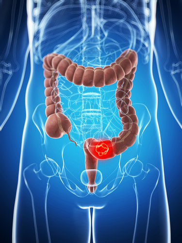 Prevenzione dei tumori intestinali