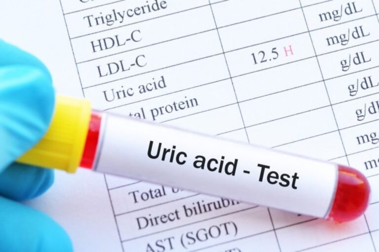 Acido urico e patrimonio genetico