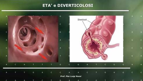 ico_Diverticolosi