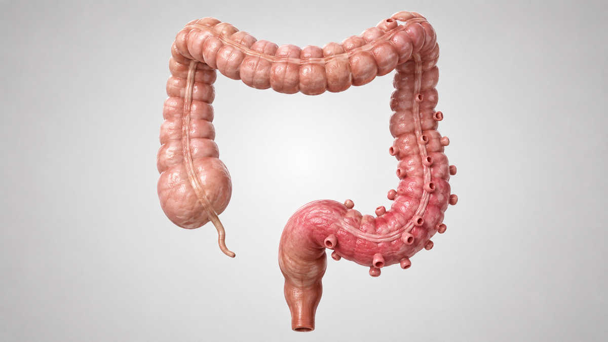 intestino crasso, con il sigma evidenziato e alcuni diverticoli visibili sulla parete