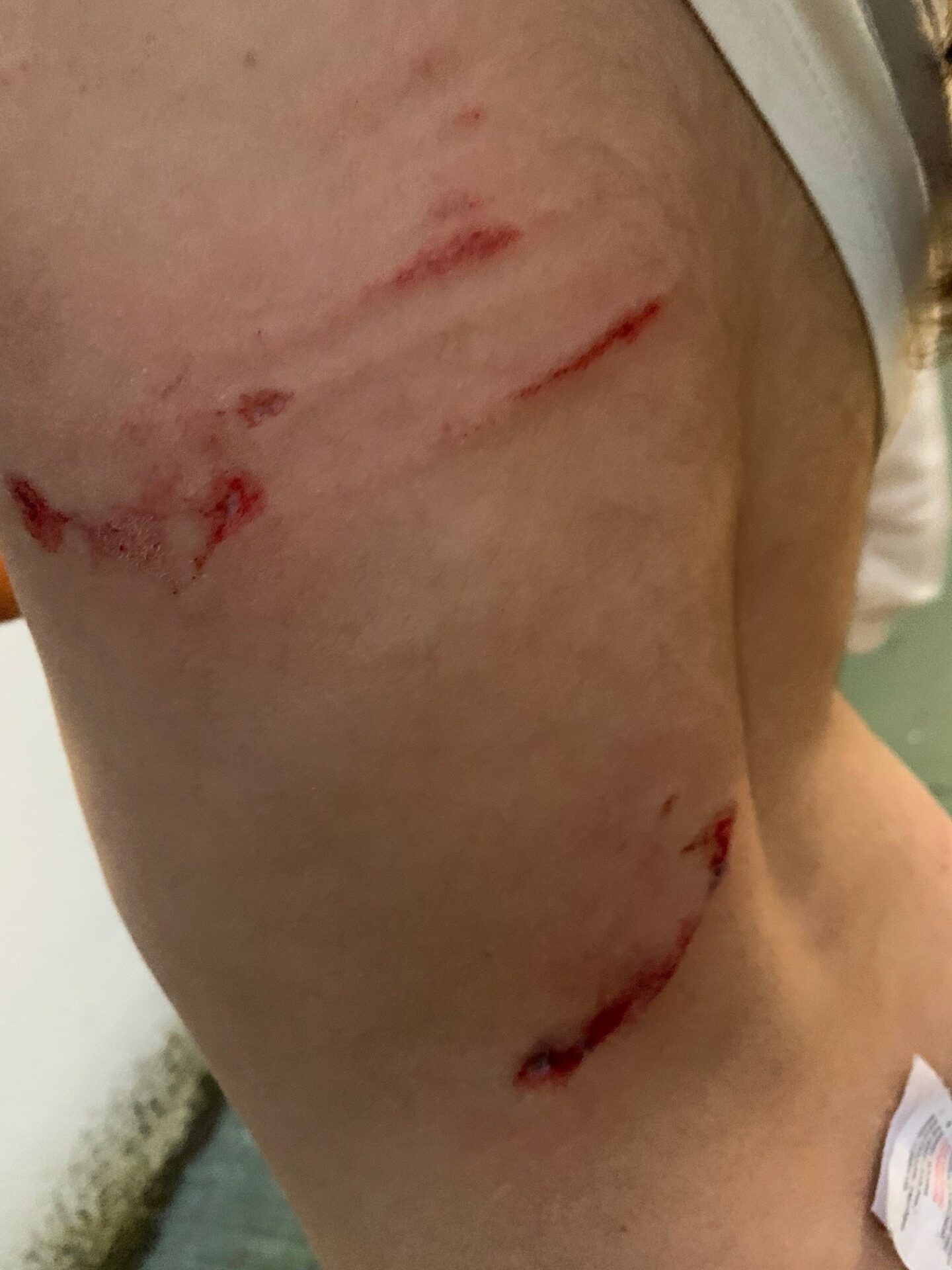 bambina di 4 anni attaccata e ferita da un lupo
